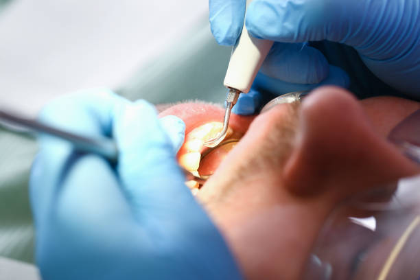 Best Emergency Tooth Extraction in Wildwood, TN